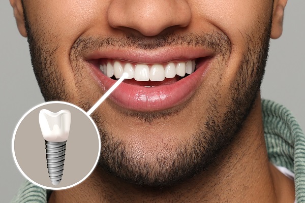 Navigating Common Myths and Misconceptions About Dental Implants