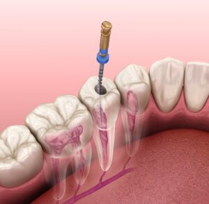 Understanding the Modern Root Canal Treatment Process and What to Expect